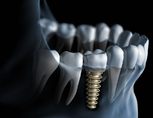 ¿Qué es la Ortodoncia Preprotésica?