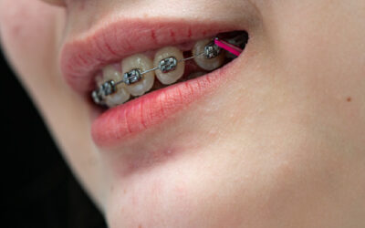 ¿Cómo corregir dientes separados con ortodoncia?