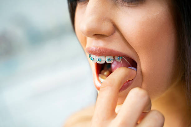 Elásticos intermaxilares en ortodoncia, ¿para qué sirven las gomas de los brackets?