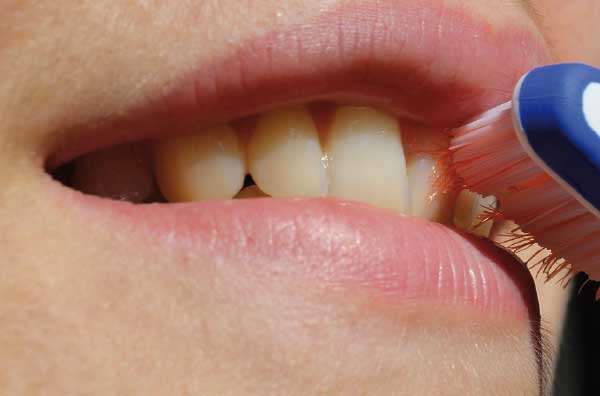 ¿Qué es la gingivitis?