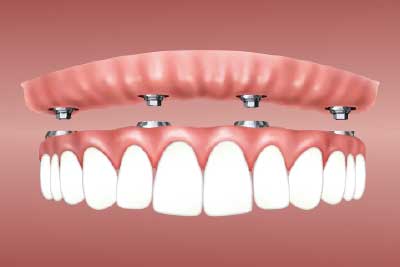 Cuidados después de una cirugía de implantes dentales.